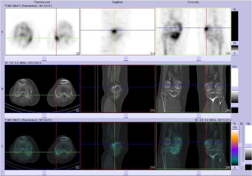 Tendinopathie sus et r&eacute;trocondylienne  gauche