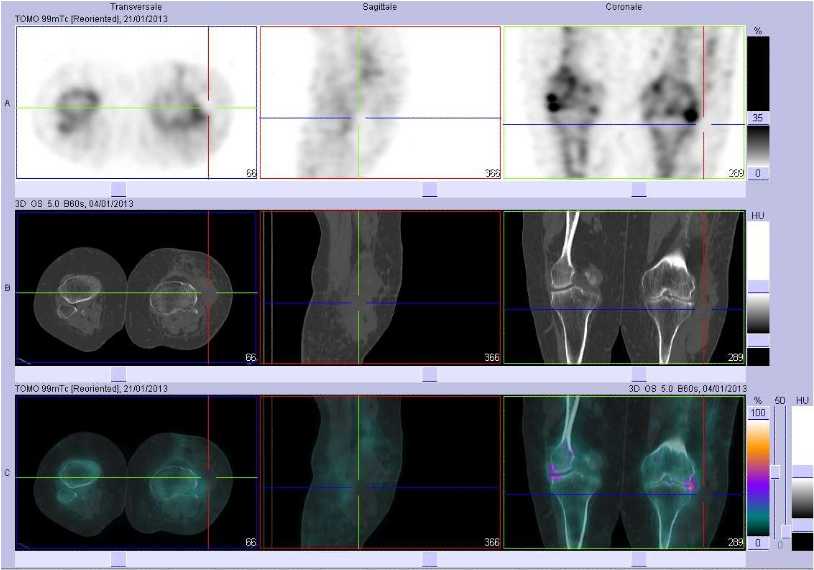 Volumineux h&eacute;matome du compartiment externe du genou gauche et de la jambe gauche