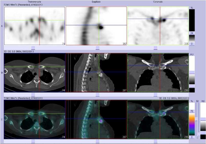 Hyperostose de l'articulation sternoclaviculaire gauche