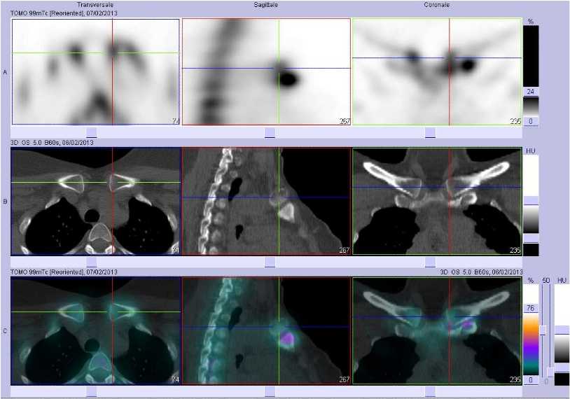 Hyperostose de l'articulation sternoclaviculaire gauche