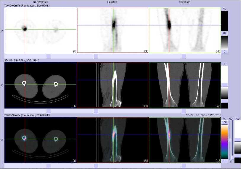Fracture de fatigue corticale du tiers moyen du f&eacute;mur droit