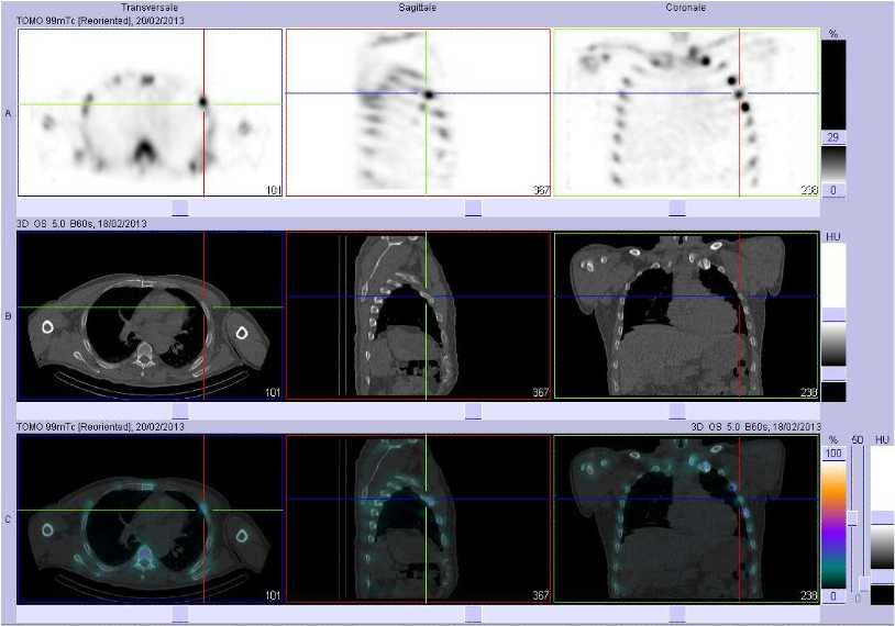 Fractures de c&ocirc;tes d'allure traumatique