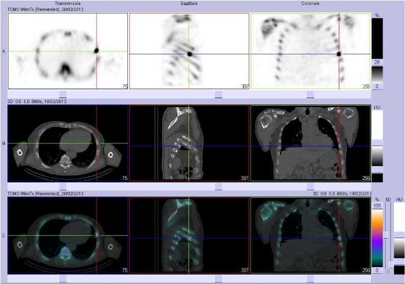 Fractures de c&ocirc;tes d'allure traumatique