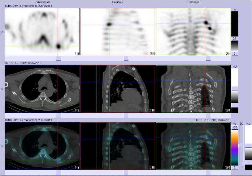 Fractures de c&ocirc;tes pathologiques