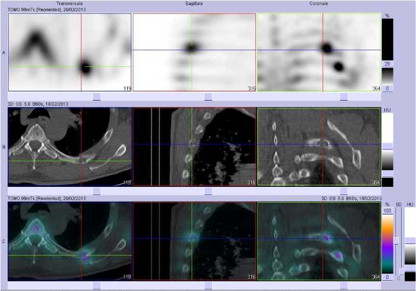 Fractures de c&ocirc;tes pathologiques
