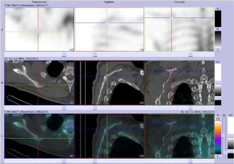 L&eacute;sions lytiques scapulaires 