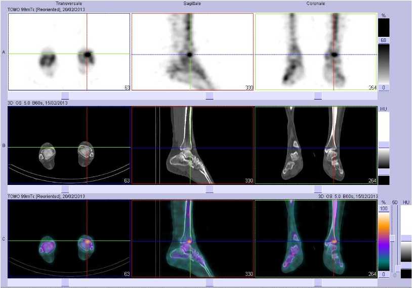 Fracture sous chondrale du pilon tibial gauche