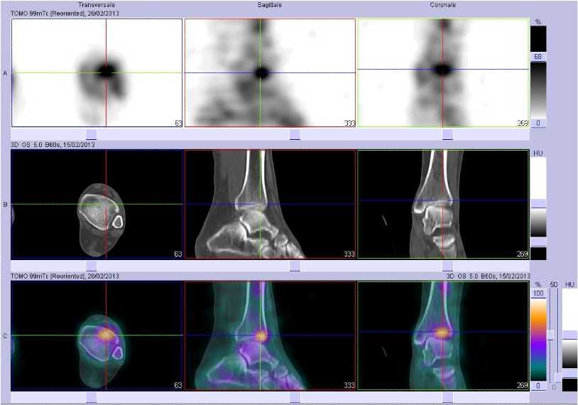 Fracture sous chondrale du pilon tibial gauche