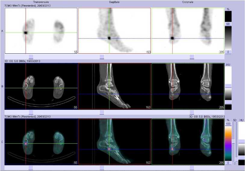 Pathologie de l'os fibulaire droit