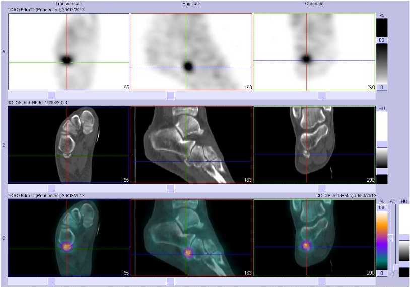 Pathologie de l'os fibulaire droit