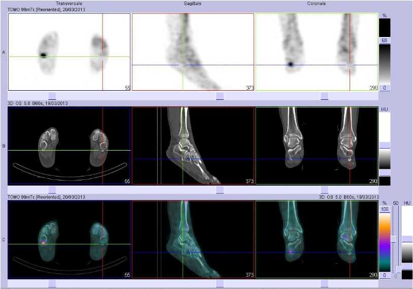 Absence de pathologie de l'os fibulaire gauche