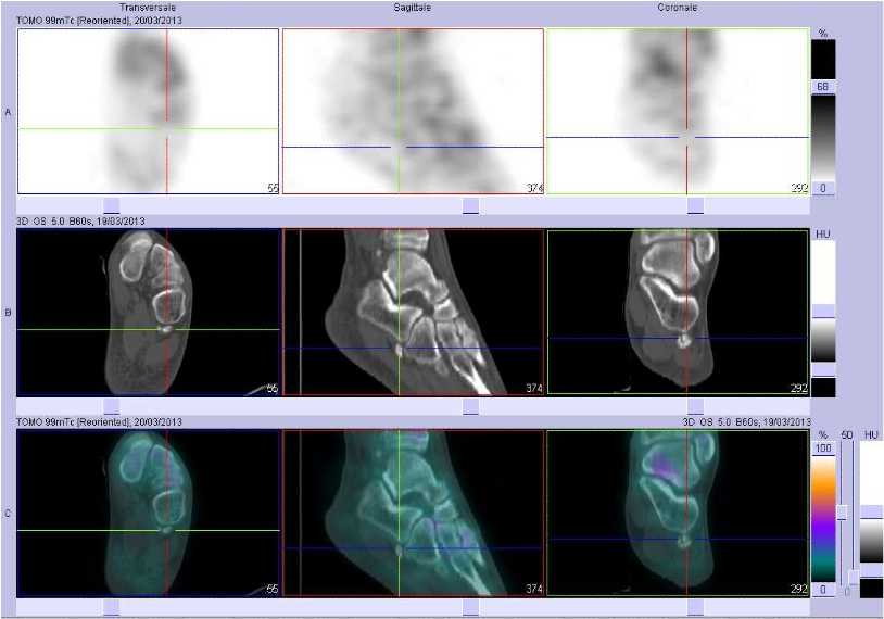 Absence de pathologie de l'os fibulaire gauche