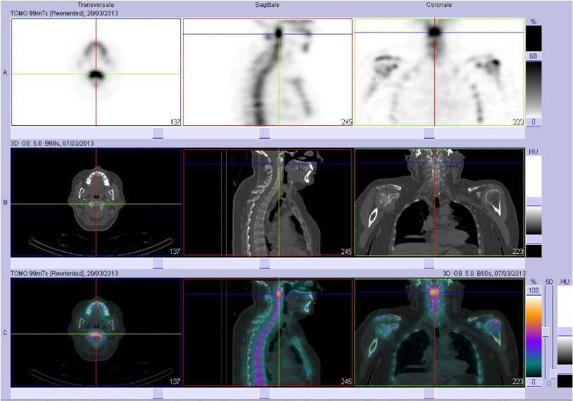 Atteinte inflammatoire C1/C2