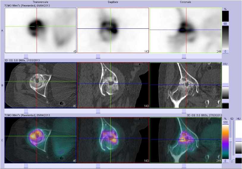 Coxarthrose droite &eacute;volu&eacute;e