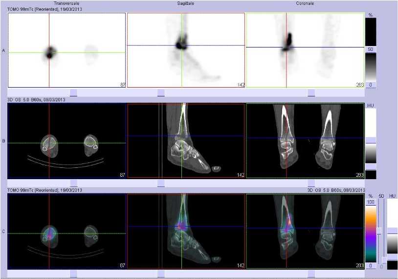 Fracture de l'extr&eacute;mit&eacute; inf&eacute;rieure du tibia droit