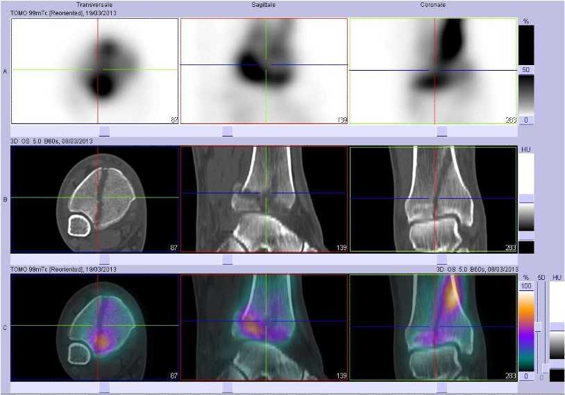 Fracture de l'extr&eacute;mit&eacute; inf&eacute;rieure du tibia droit