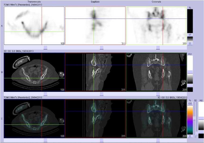 Fracture de l'aile iliaque gauche