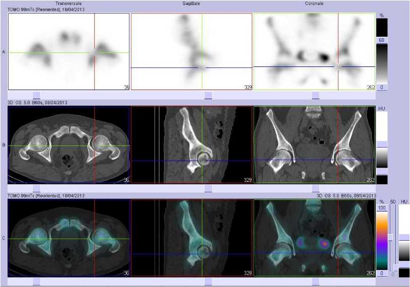 Superscan m&eacute;tastatique