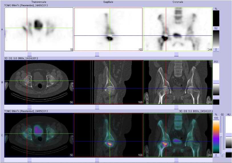 Fracture du col f&eacute;moral droit