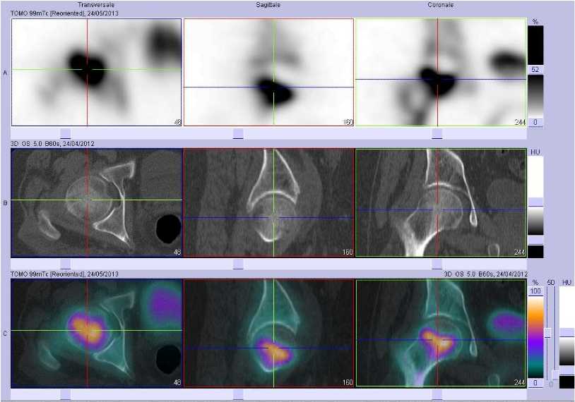 Fracture du col f&eacute;moral droit