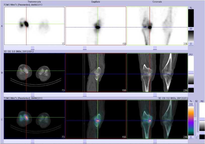 Fracture sous chondrale du condyle f&eacute;moral m&eacute;dial droit