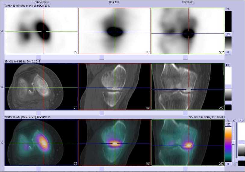 Fracture sous chondrale du condyle f&eacute;moral m&eacute;dial droit
