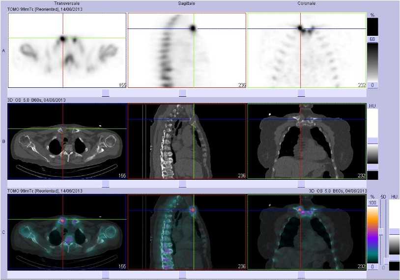 Atteinte inflammatoire du plastron sterno costo claviculaire