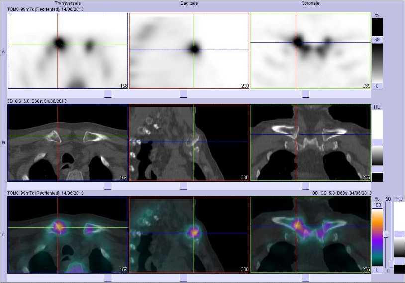 Atteinte inflammatoire du plastron sterno costo claviculaire