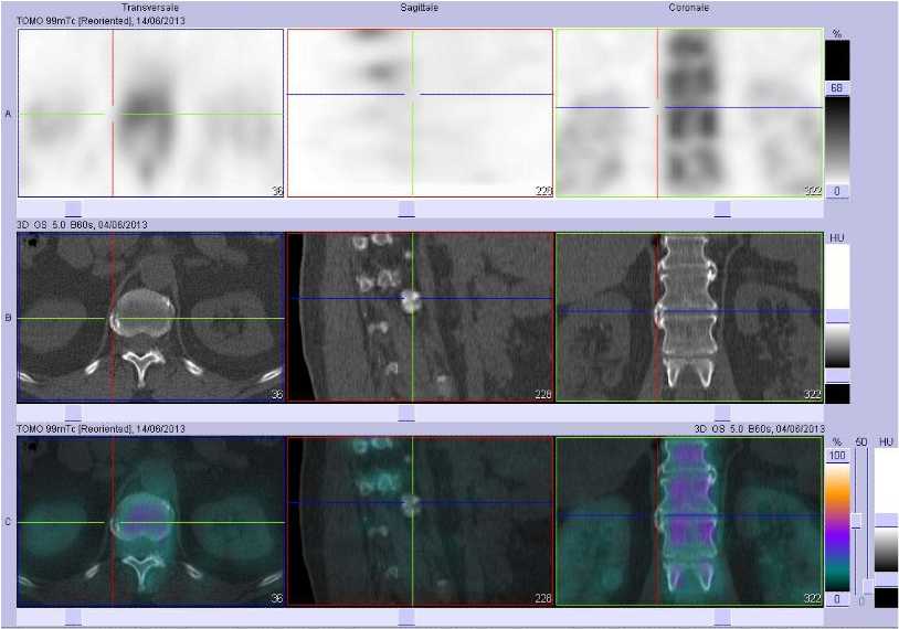 Probables syndesmophytes au niveau de la jonction thoraco lombaire