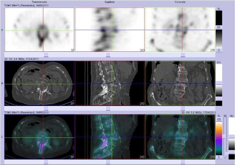 Tassement vert&eacute;bral r&eacute;cent de L3 sur vert&egrave;bre pathologique