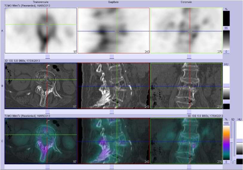 Tassement vert&eacute;bral r&eacute;cent de L3 sur vert&egrave;bre pathologique