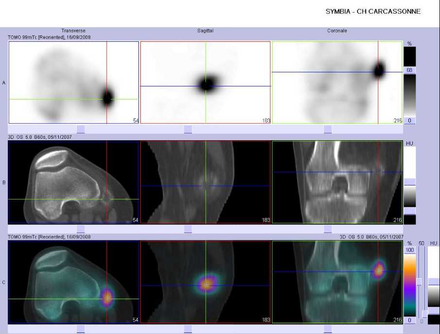 H&eacute;matome calcifi&eacute;
