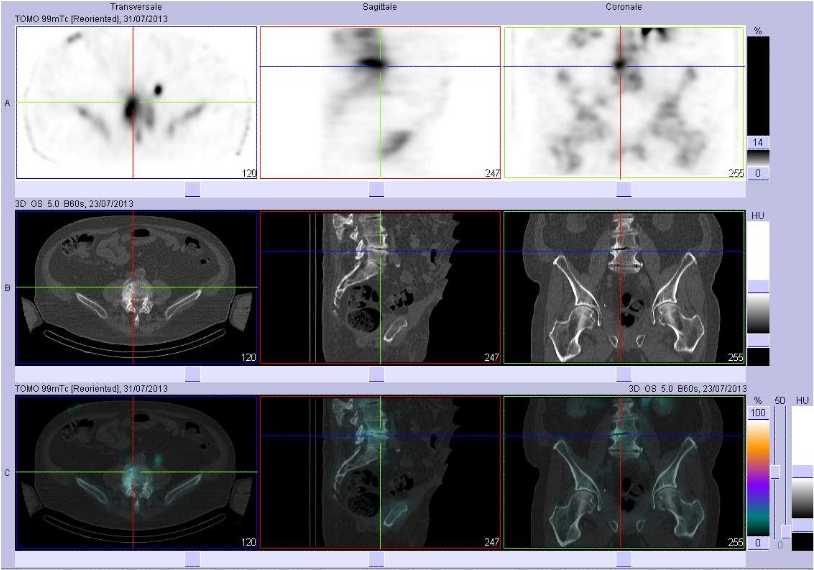 Discopathie arthrosique L4/L5