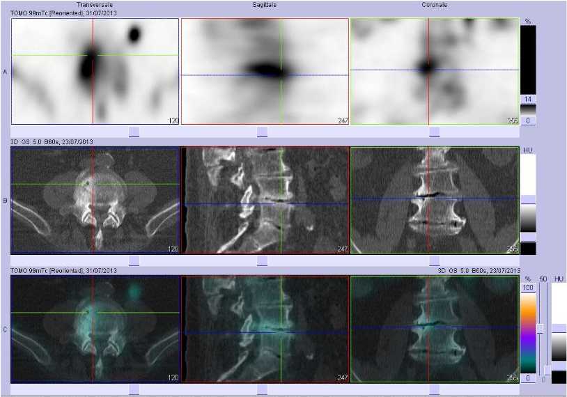 Discopathie arthrosique L4/L5