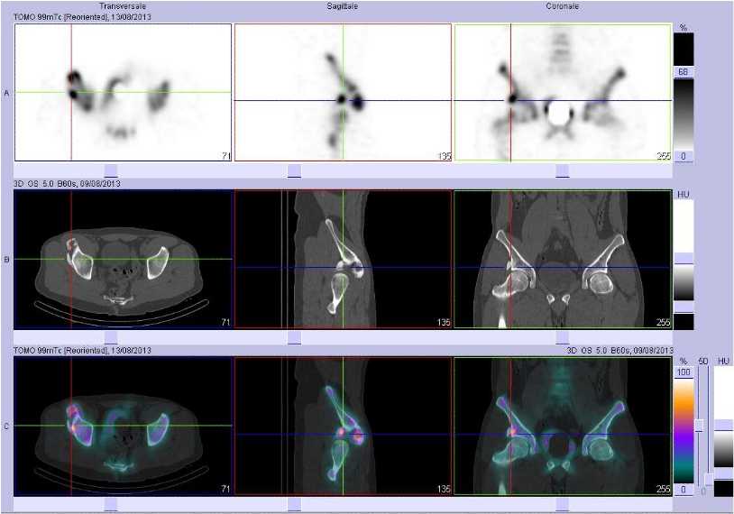 Ossifications musculo tendineuses sus et lat&eacute;ro cotylo&iuml;diennes droites