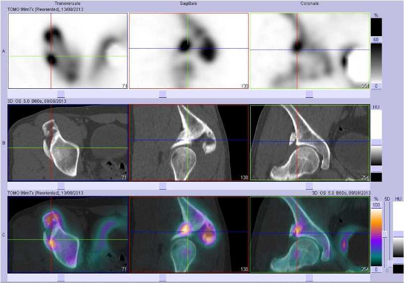 Ossifications musculo tendineuses sus et lat&eacute;ro cotylo&iuml;diennes droites