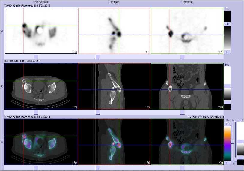 Ossifications musculo tendineuses sus et ant&eacute;ro cotylo&iuml;diennes droites