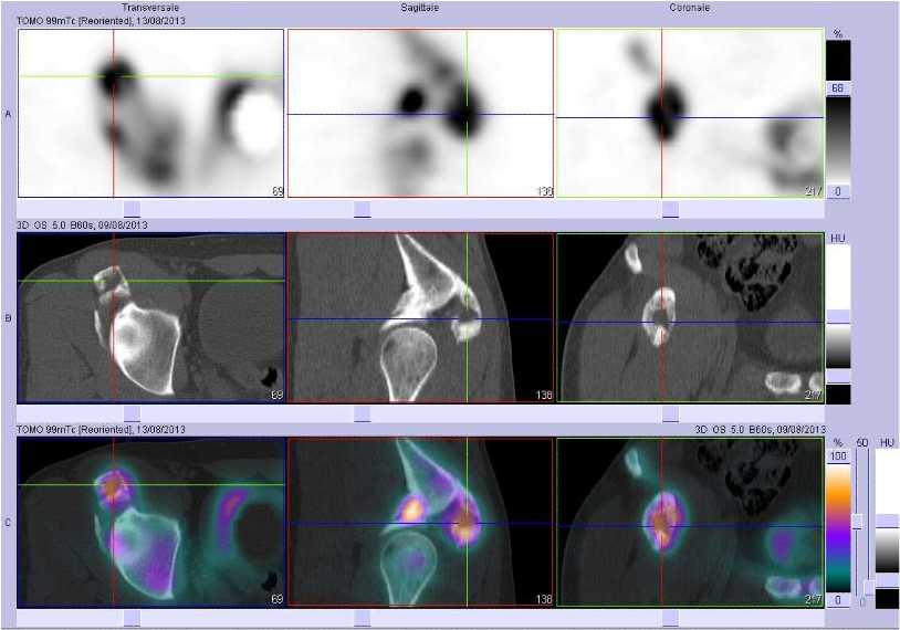 Ossifications musculo tendineuses sus et ant&eacute;ro cotylo&iuml;diennes droites