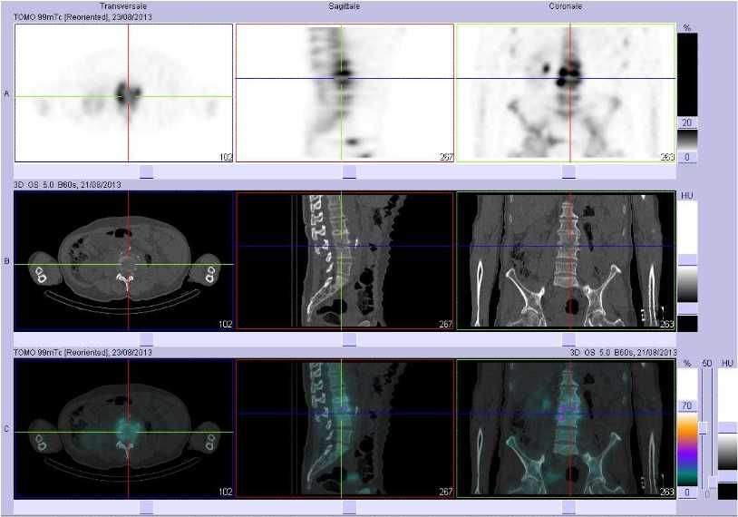 Spondylodiscite L3/L4