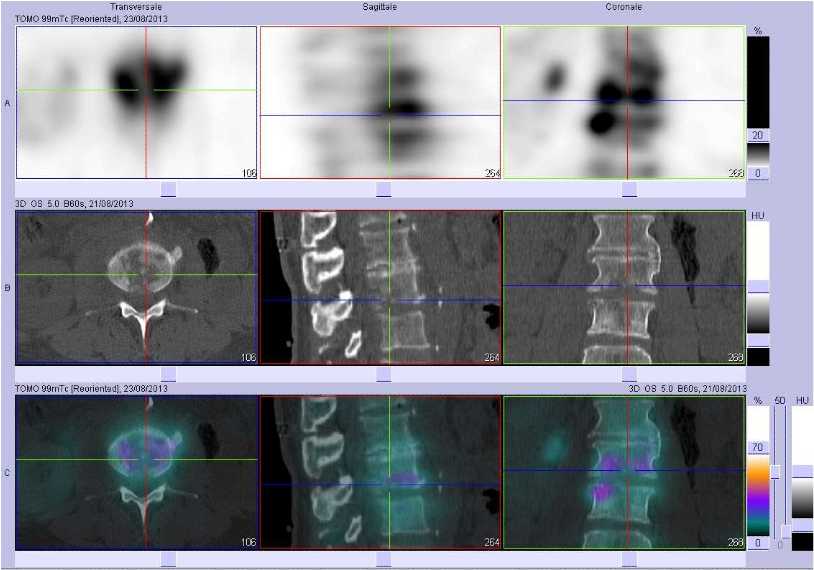 Spondylodiscite L3/L4