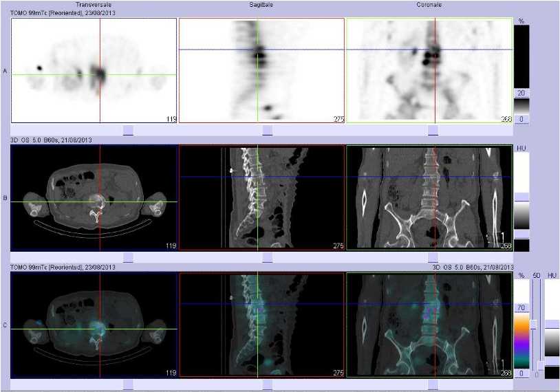 Probable spondylodiscite L2/L3
