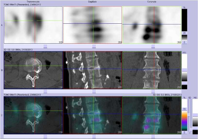 Probable spondylodiscite L2/L3
