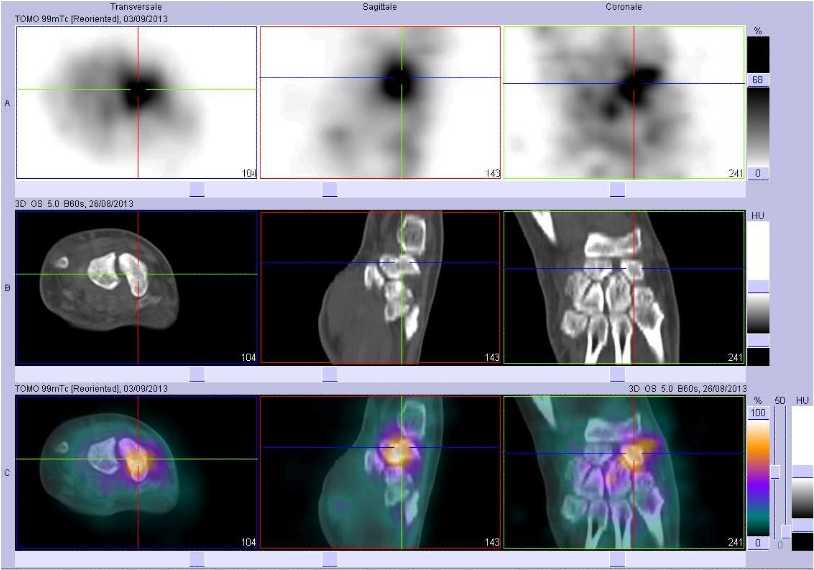 Fracture du scapho&iuml;de droit