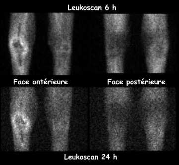 Scintigraphie aux anticorps antigranulocytes marqu&eacute;s (Leukoscan)