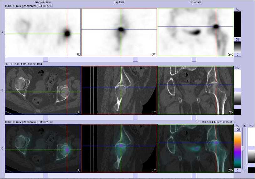 Fracture sous-chondrale de la t&ecirc;te f&eacute;morale gauche