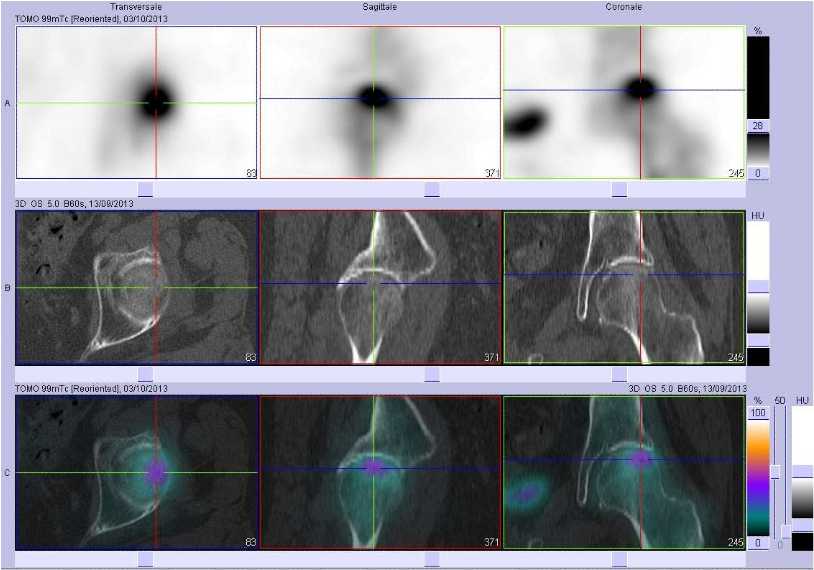 Fracture sous-chondrale de la t&ecirc;te f&eacute;morale gauche