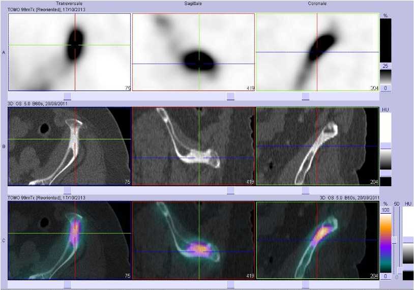 M&eacute;tastase ost&eacute;ocondensante de l'aile iliaque gauche