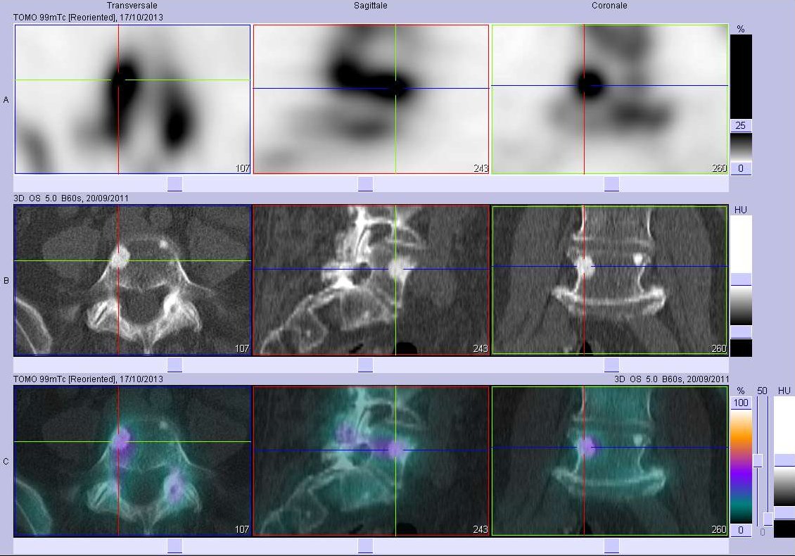 M&eacute;tastase ost&eacute;ocondensante du corps vert&eacute;bral de L5
