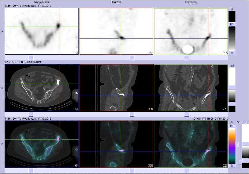 M&eacute;tastase ost&eacute;ocondensante de l'aile iliaque gauche