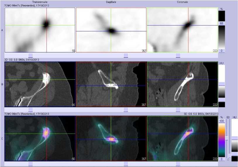 M&eacute;tastase ost&eacute;ocondensante de l'aile iliaque gauche